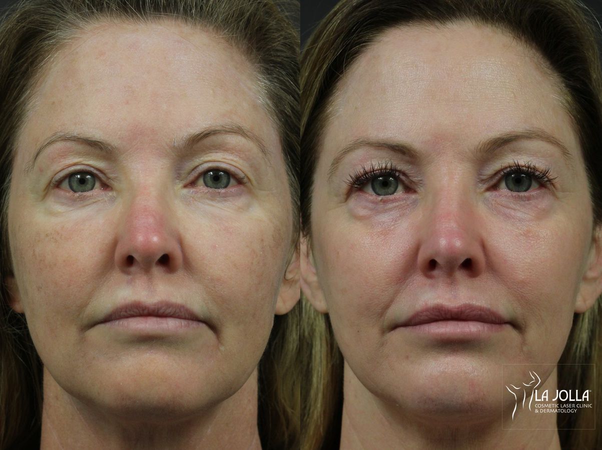 Before and after Fraxel® case 36261 - Angle 3