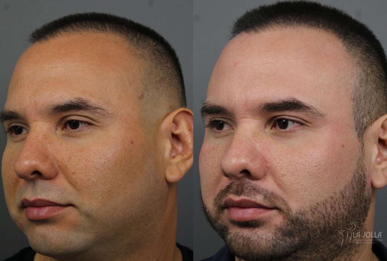 Before and after Fraxel® case 36183 - Angle 2