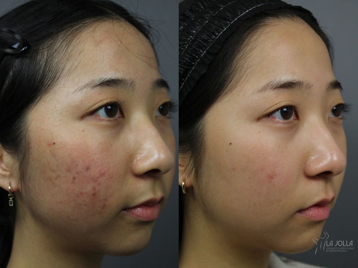 Before and after Fraxel® case 36117 - Angle 3