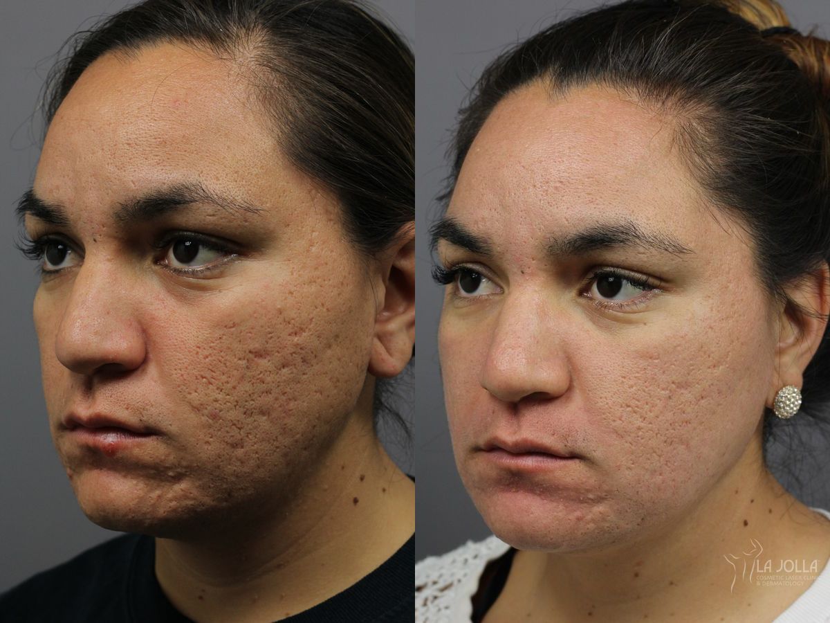 Before and after Fraxel® case 36284
