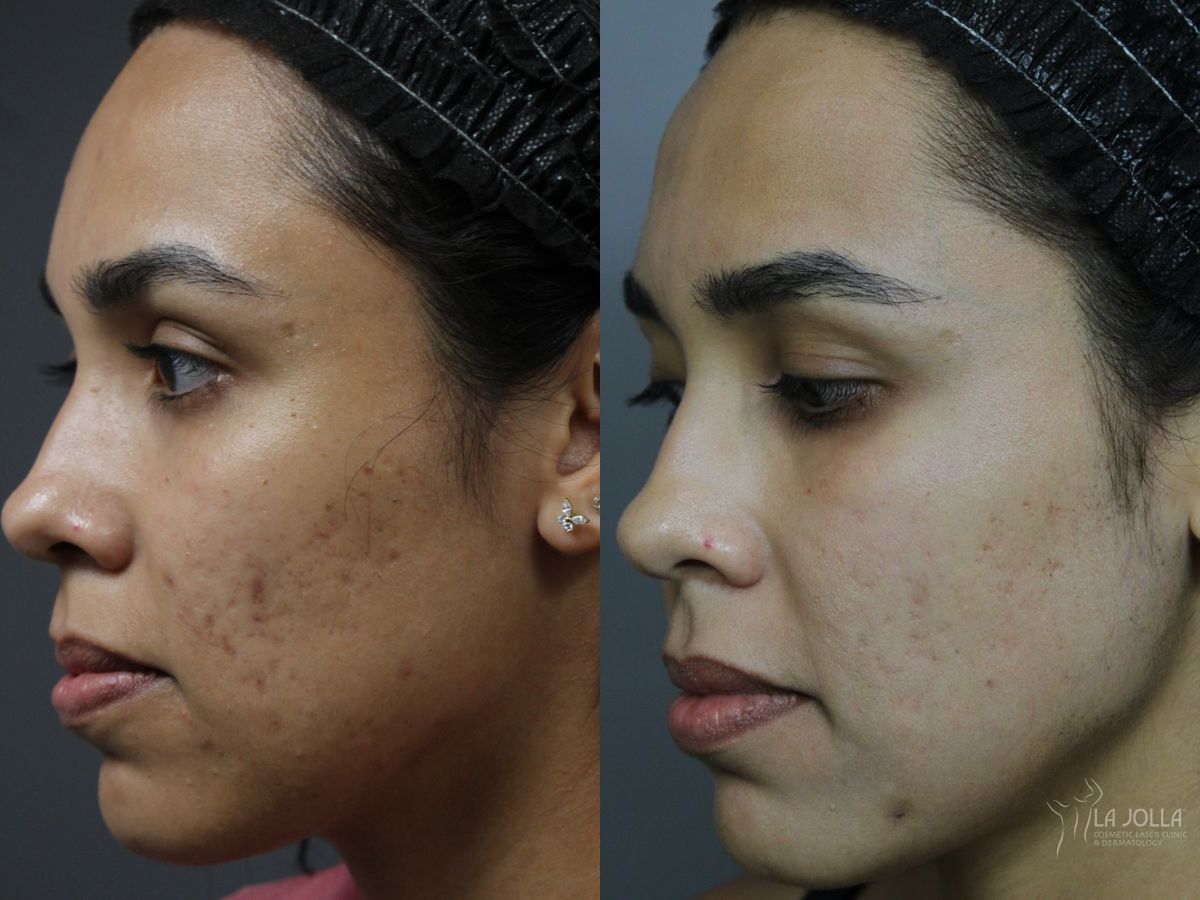Before and after Fraxel® case 46320 - Angle 3