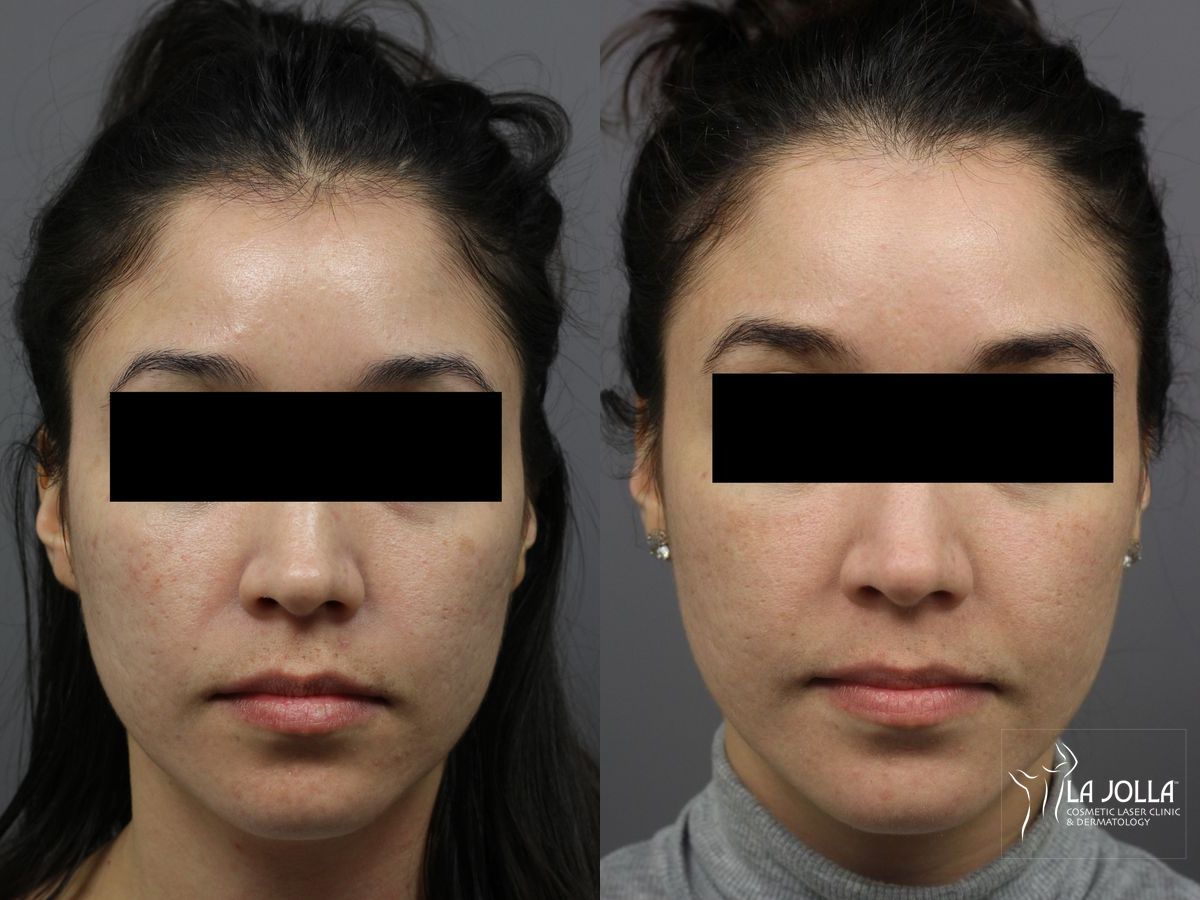 Before and after Fraxel® case 36284 - Angle 2