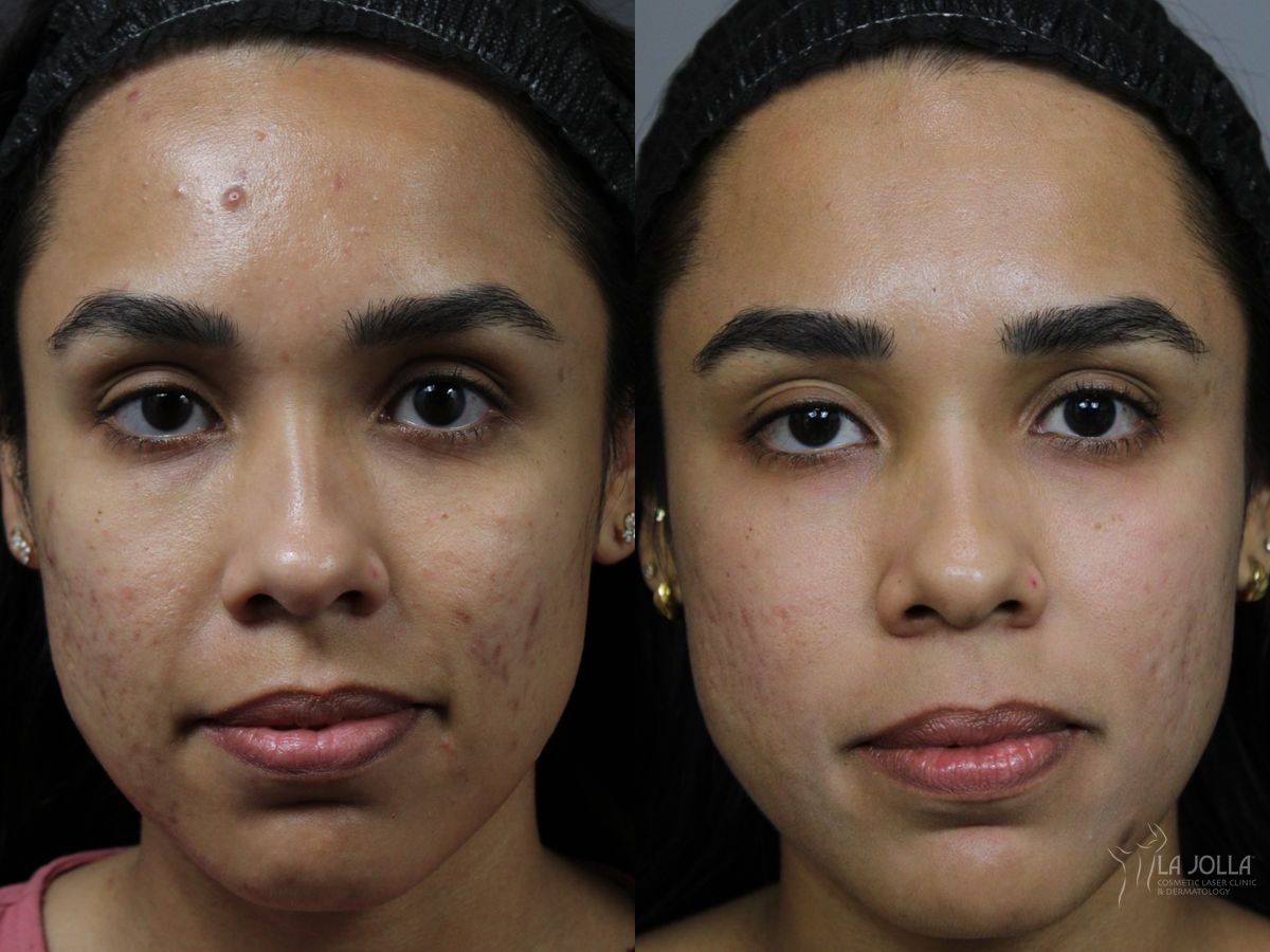 Before and after Fraxel® case 46320