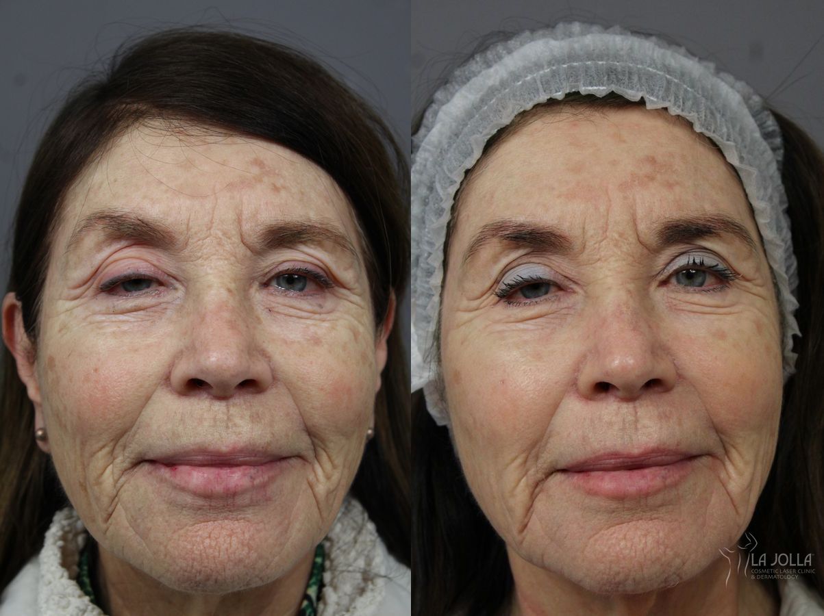Before and after Fraxel® case 36197