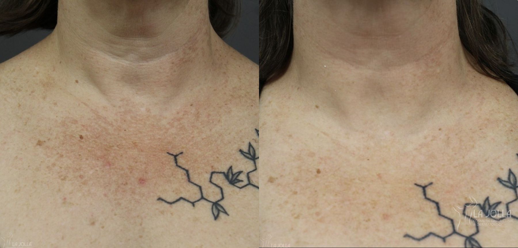 Before and after Fraxel® case 36129 - Angle 2