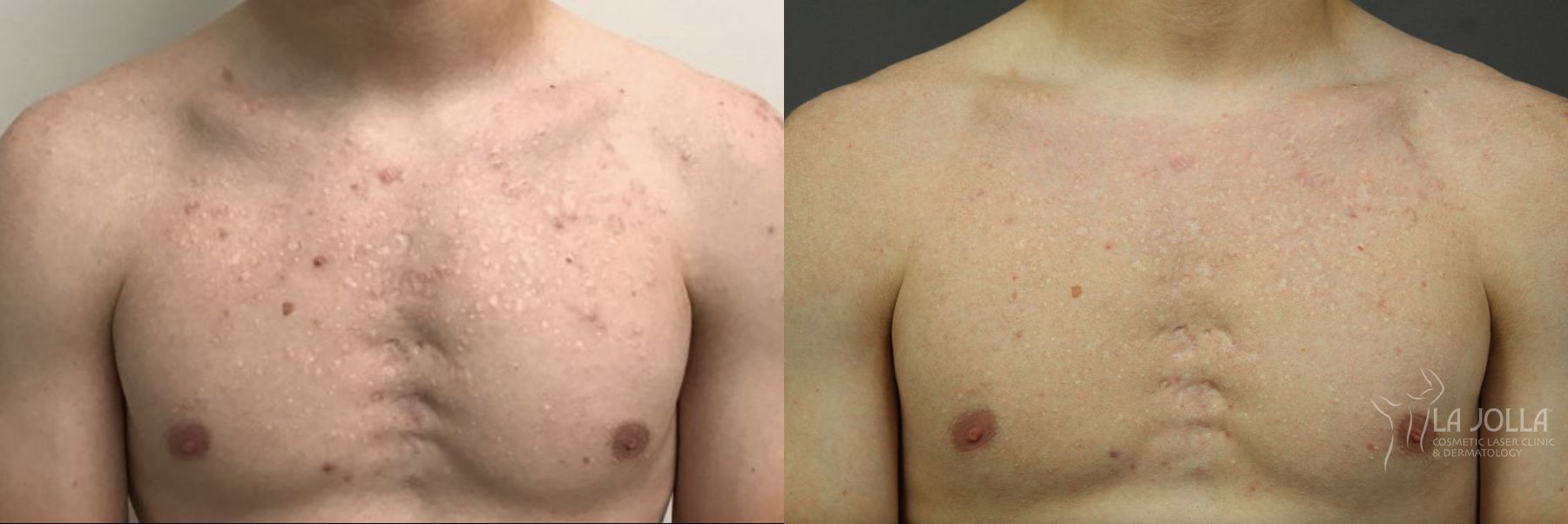 Fraxel Scar Before and After
