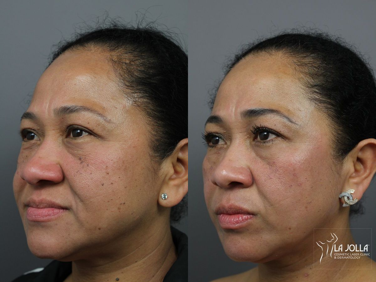 Before and after Fraxel® case 36284 - Angle 3