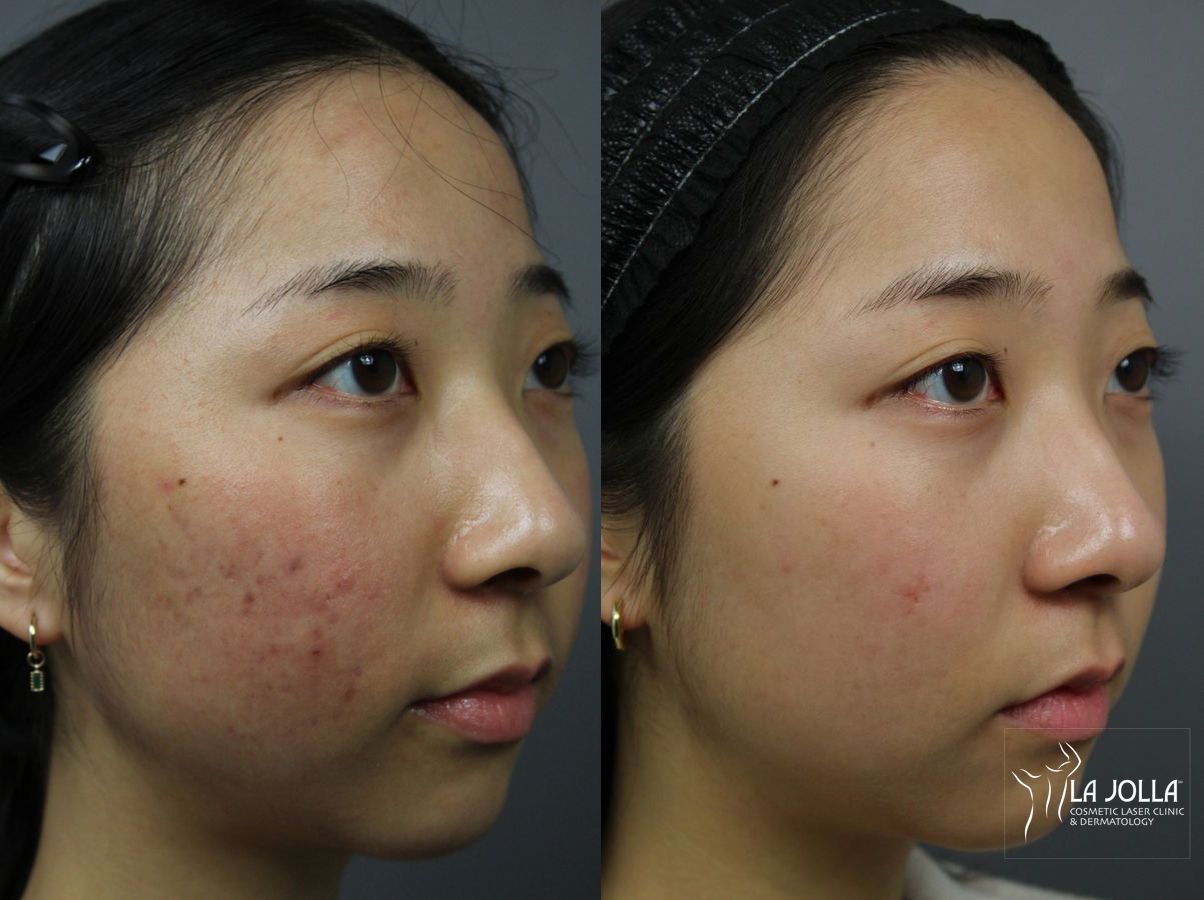 Before and after Fraxel® case 36117 - Angle 3