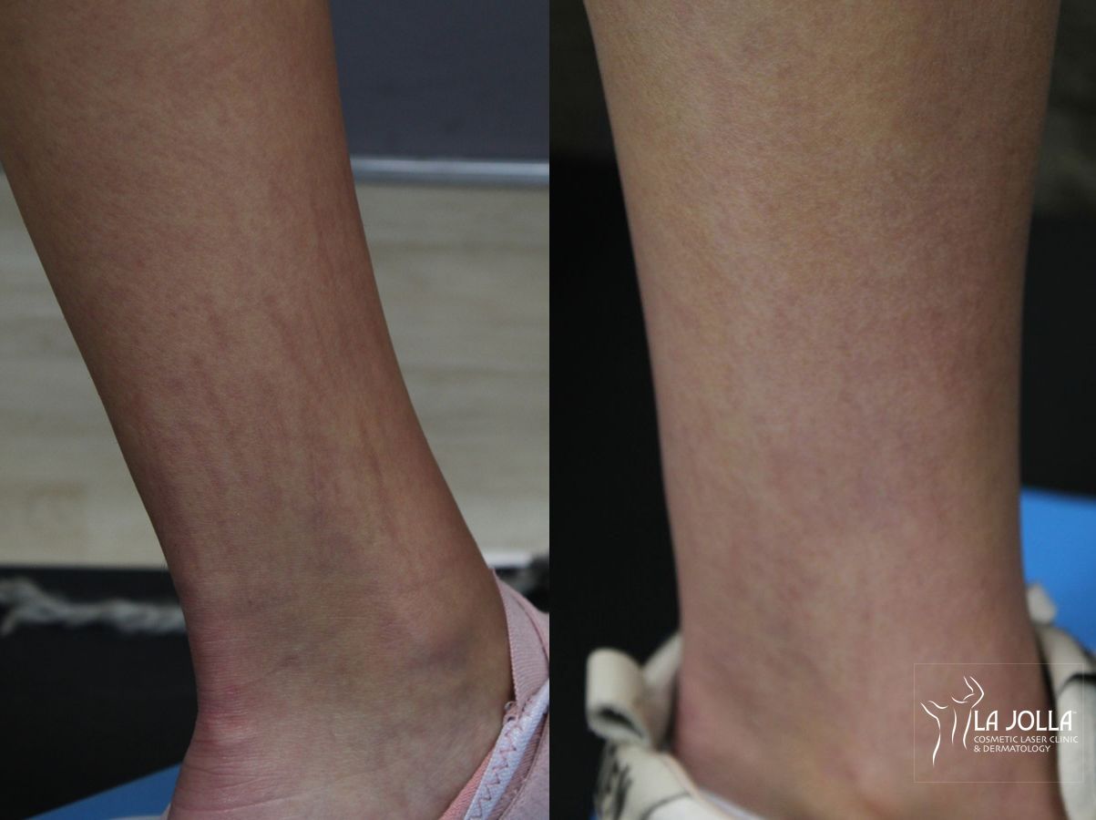 Before and after Fraxel® case 36077