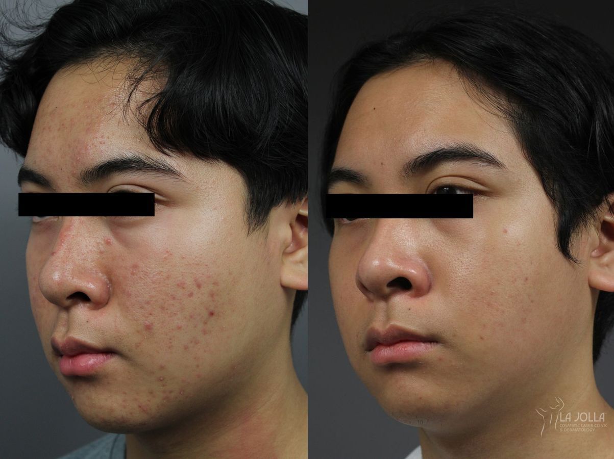 Before and after Fraxel® case 36301 - Angle 2