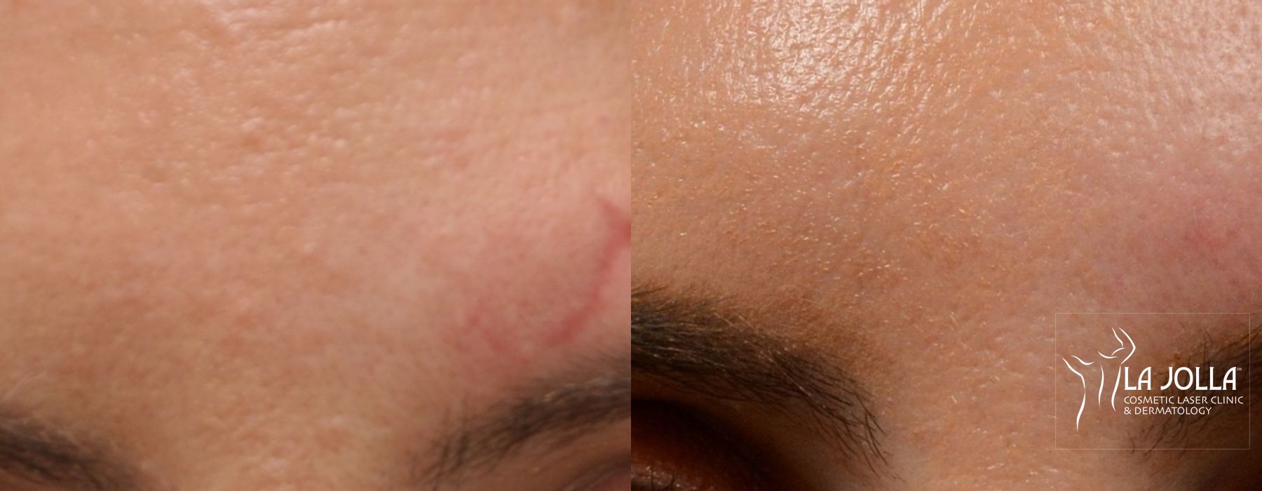 Before and after Fraxel® case 36297