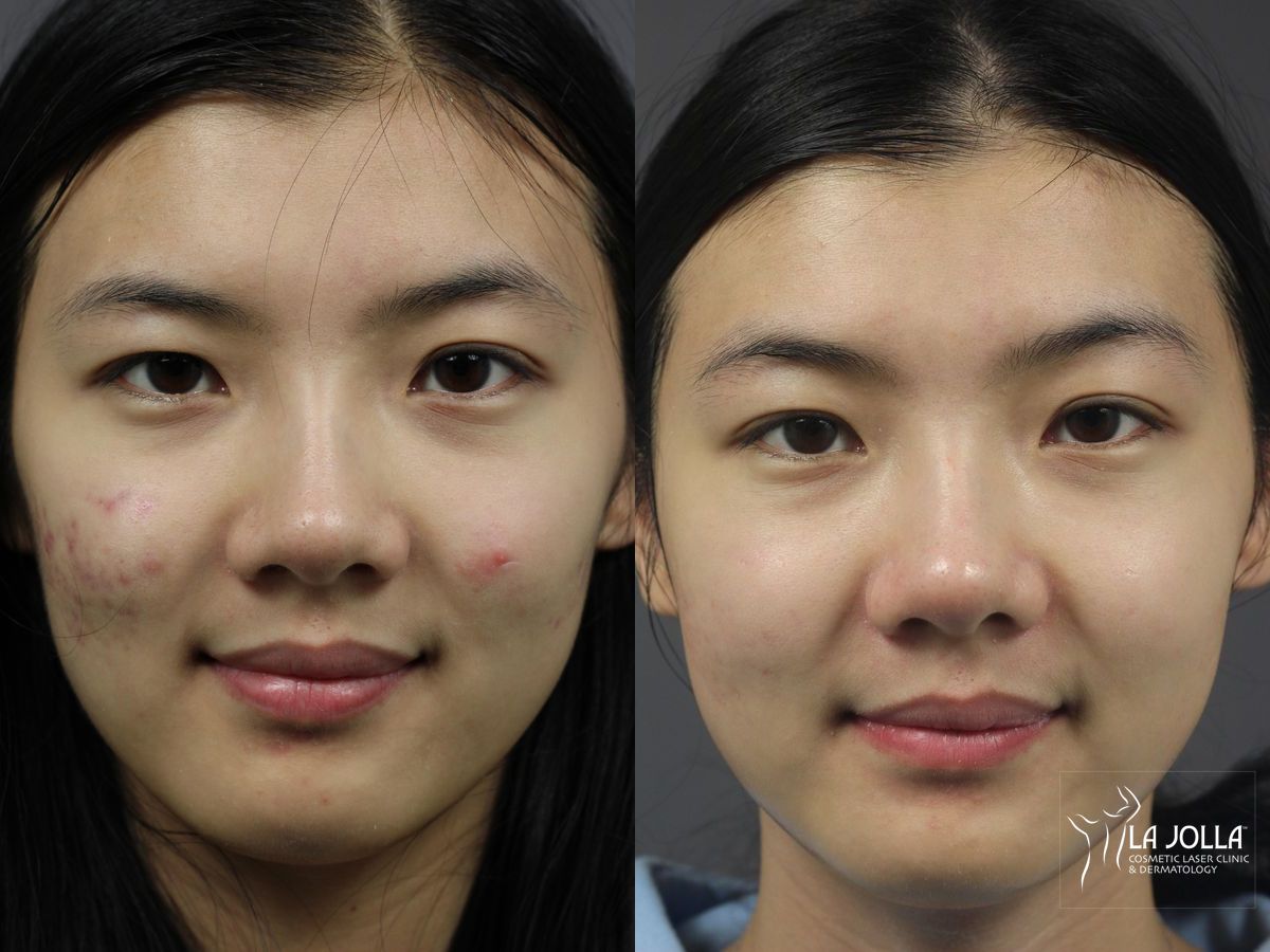 Before and after Fraxel® case 36260 - Angle 2