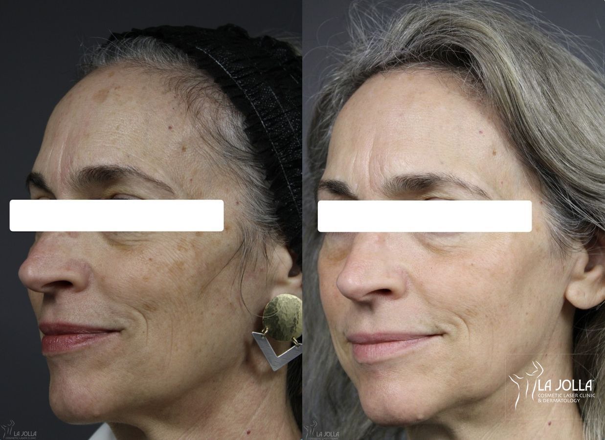 Before and after Fraxel® case 36111 - Angle 3