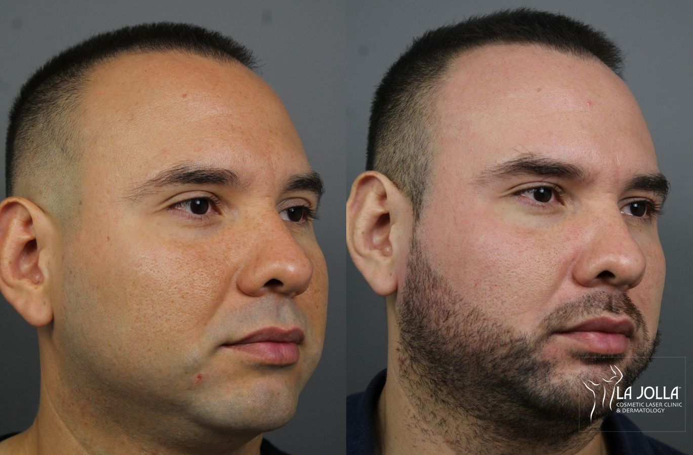 Before and after Fraxel® case 36183 - Angle 3