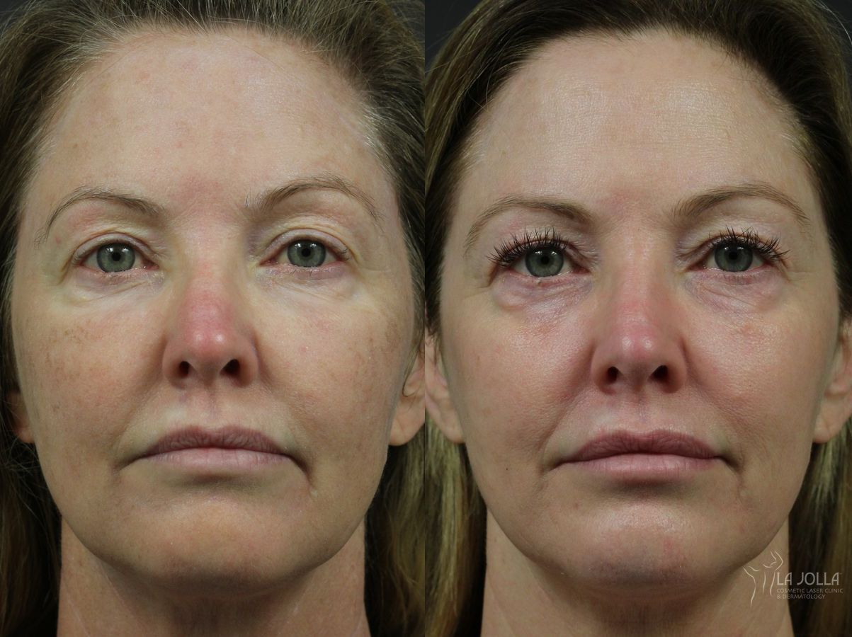 Before and after Fraxel® case 36261 - Angle 3