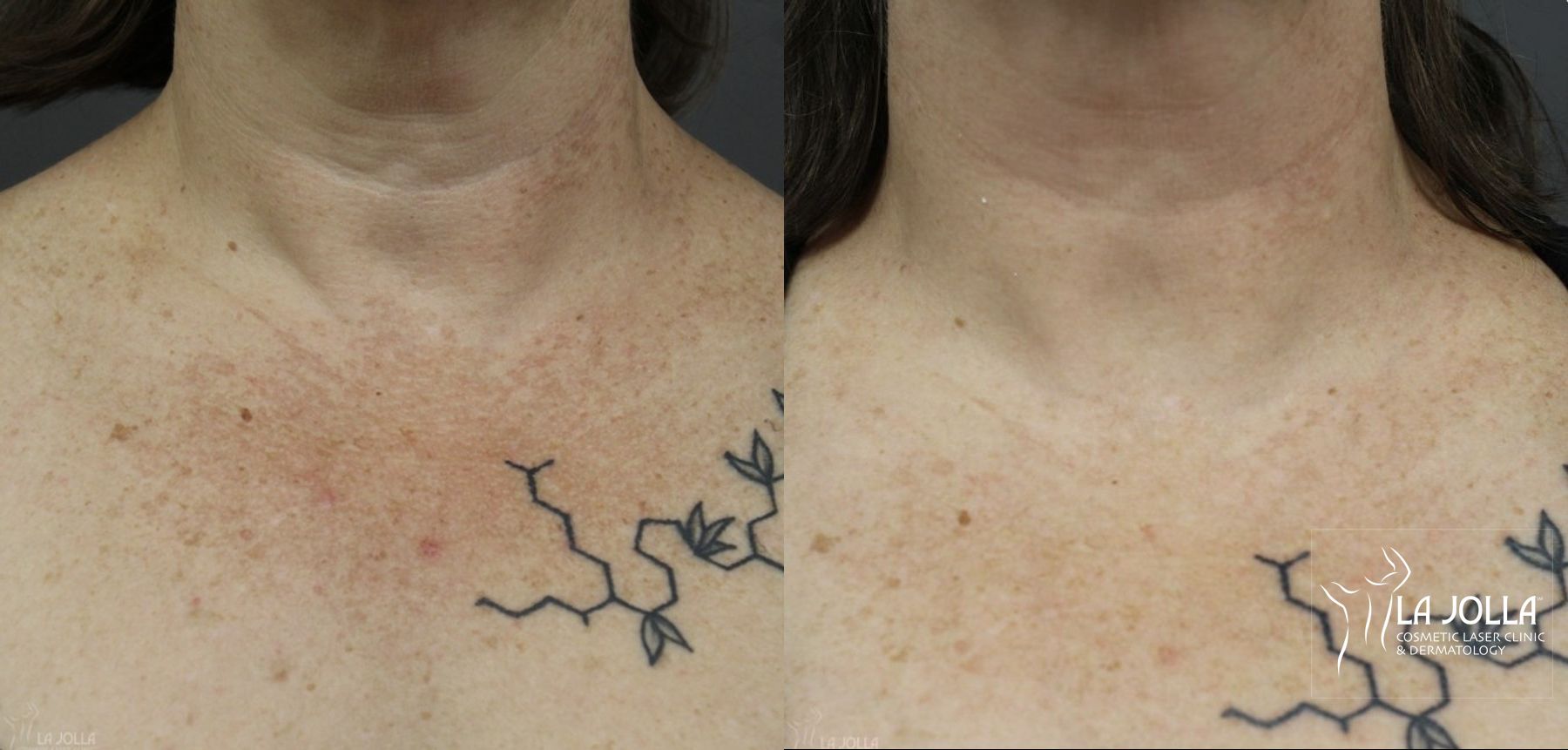 Before and after Fraxel® case 36129 - Angle 2