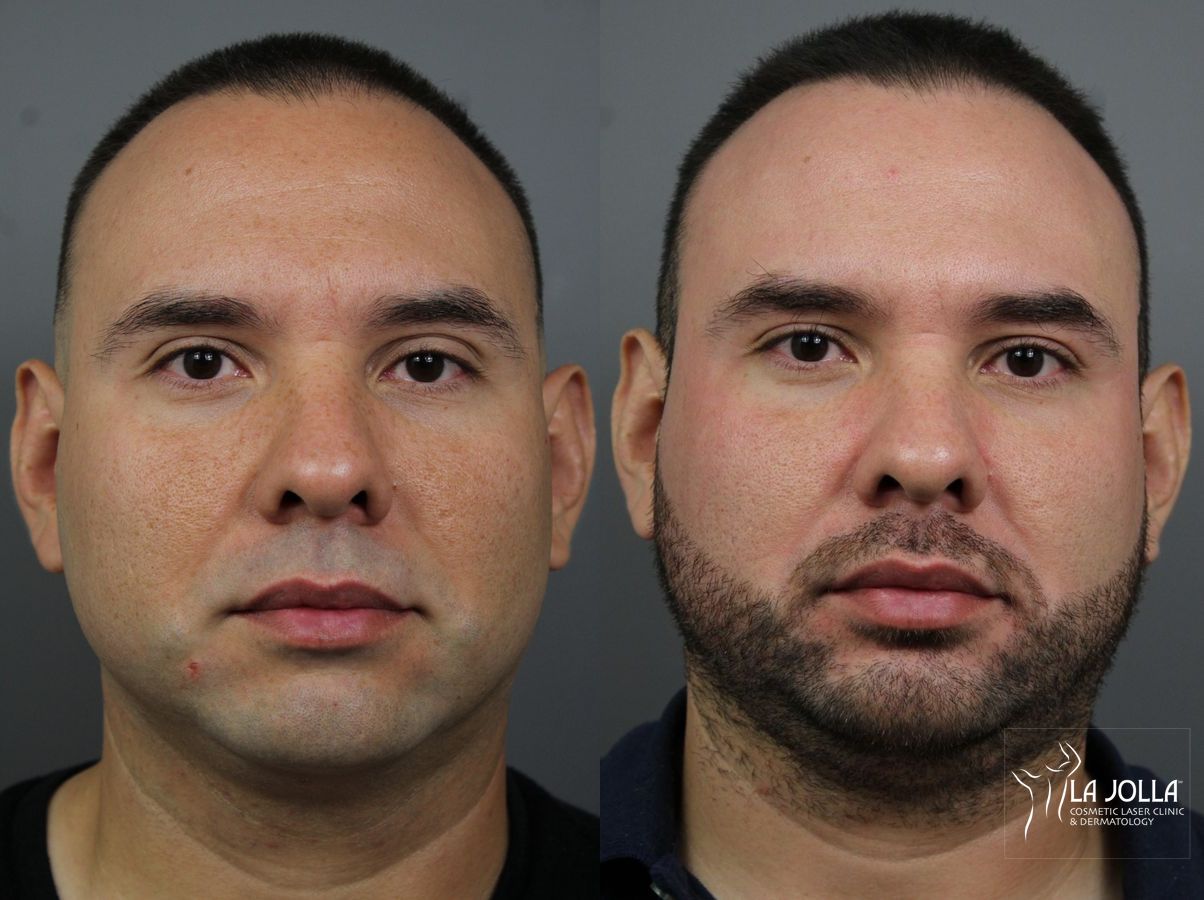 Before and after Fraxel® case 36183