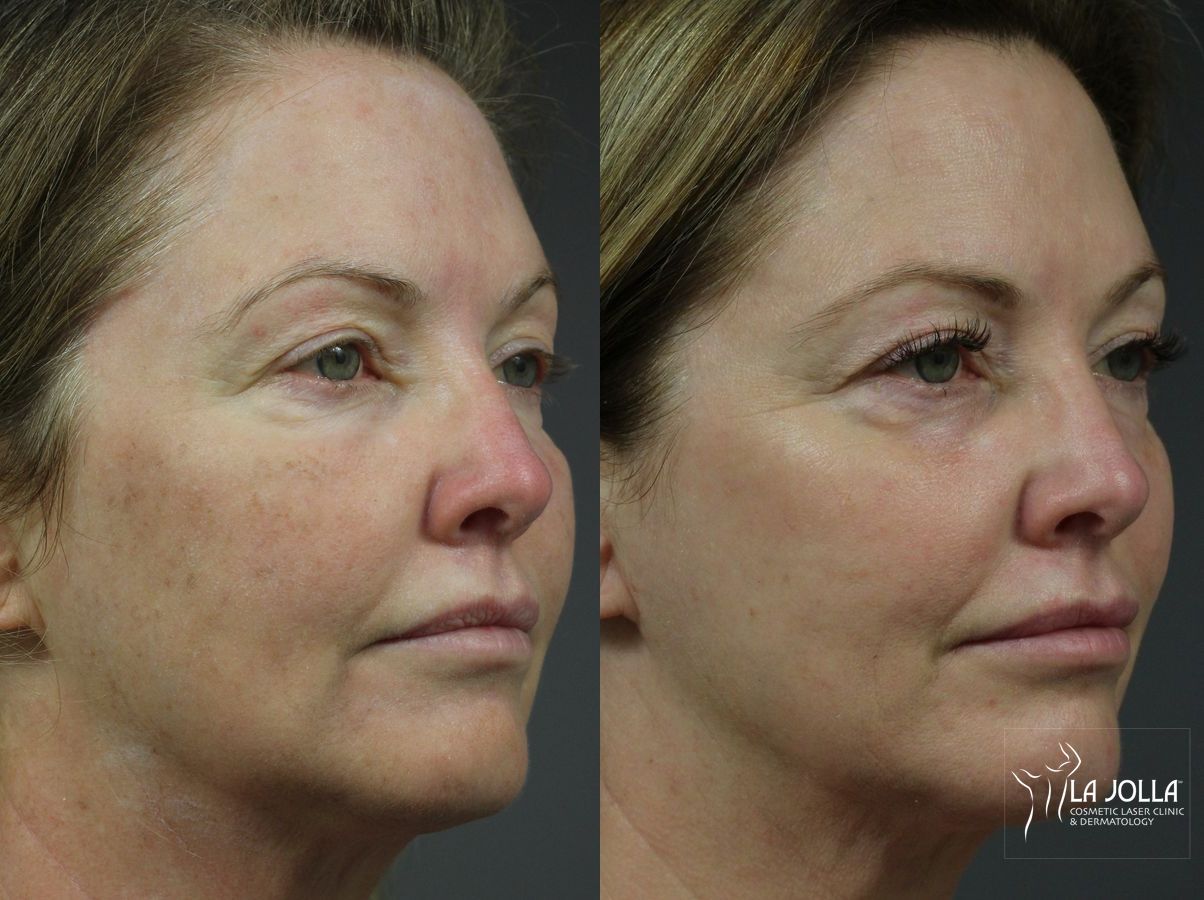 Before and after Fraxel® case 36261 - Angle 2