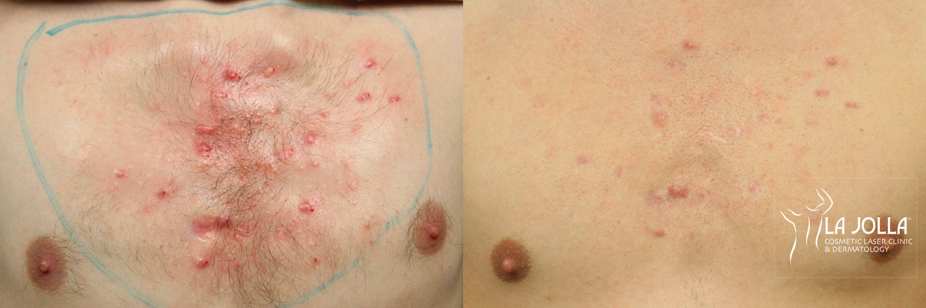 Before and after Fraxel® case 36217