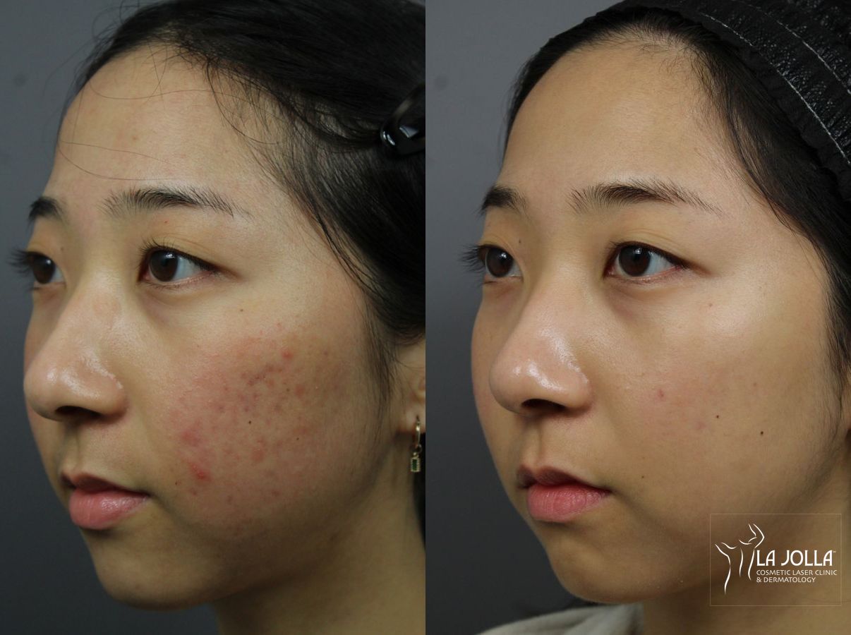 Before and after Fraxel® case 36117 - Angle 2