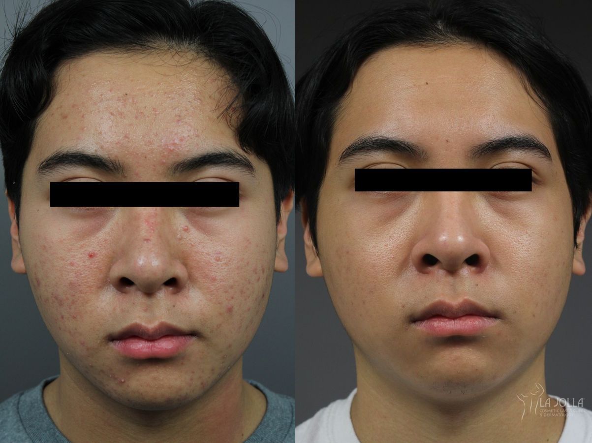 Before and after Fraxel® case 36301