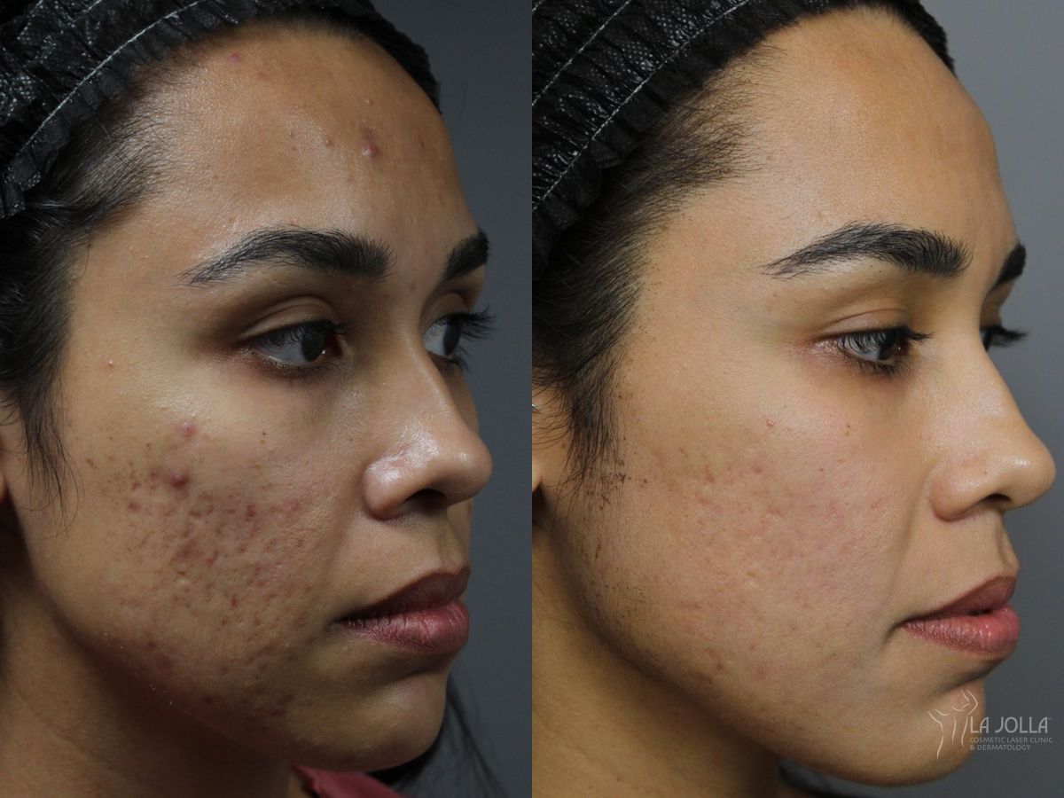 Before and after Fraxel® case 46320 - Angle 2