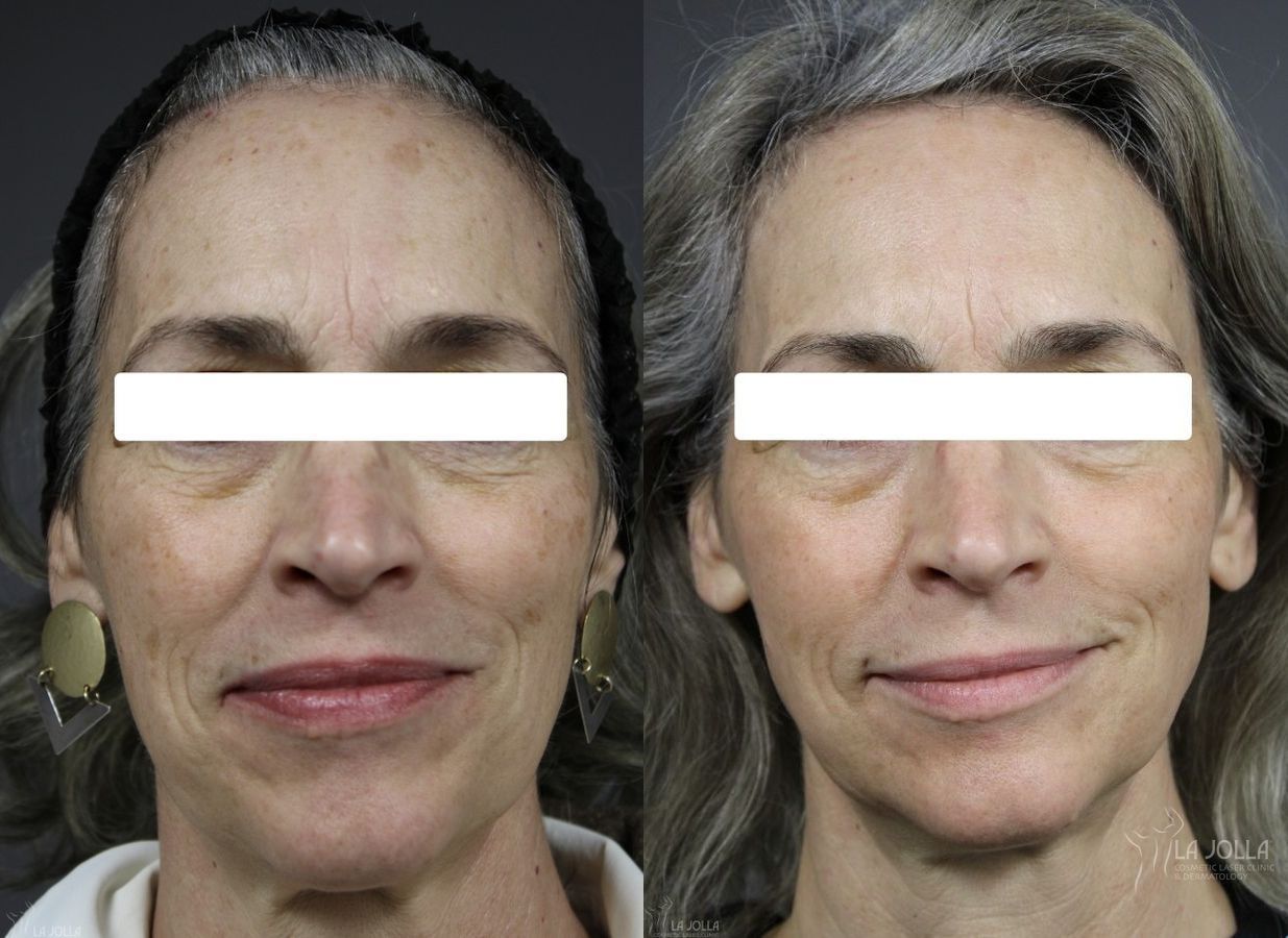 Before and after Fraxel® case 36111