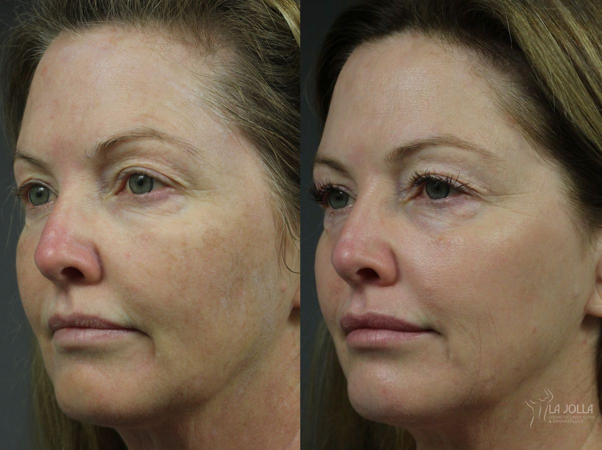 Before and after Fraxel® case 36261