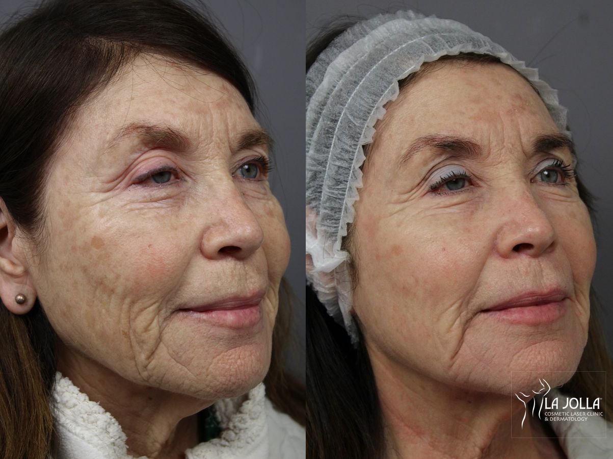 Before and after Fraxel® case 36197 - Angle 2