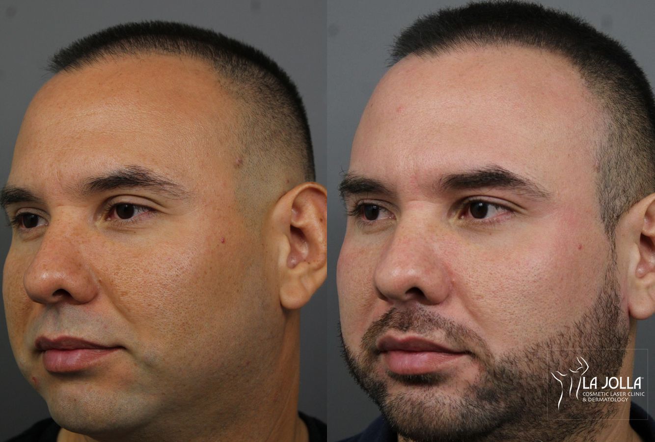 Before and after Fraxel® case 36183 - Angle 2