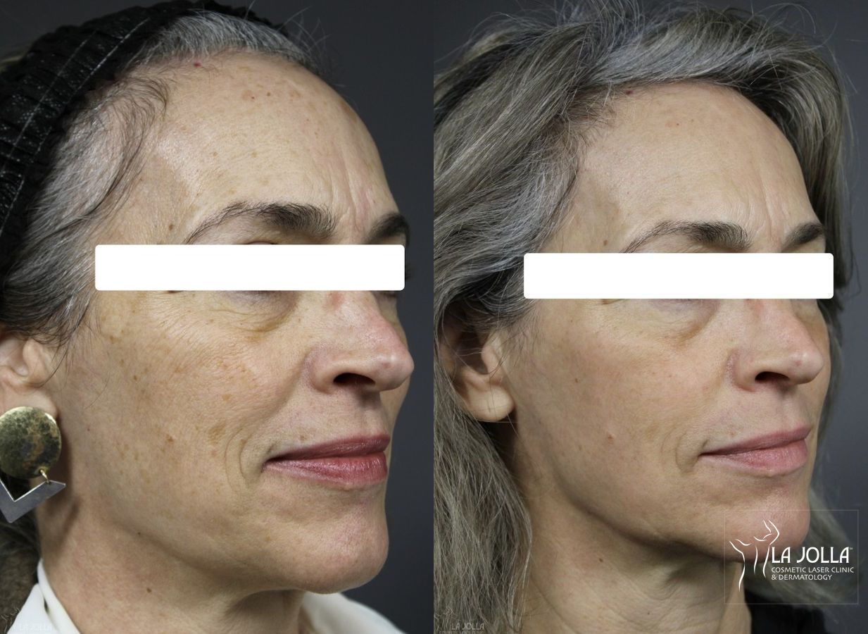 Before and after Fraxel® case 36111 - Angle 2