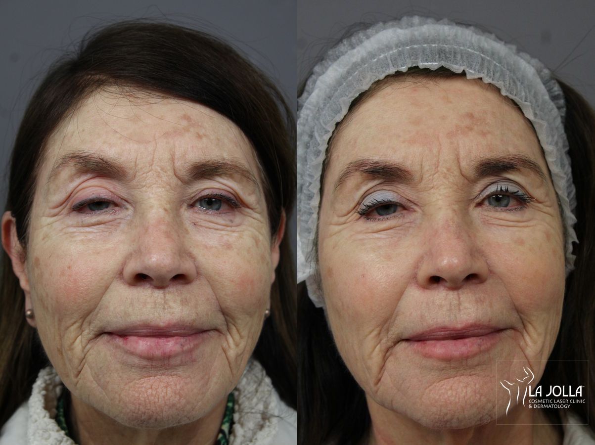 Before and after Fraxel® case 36197