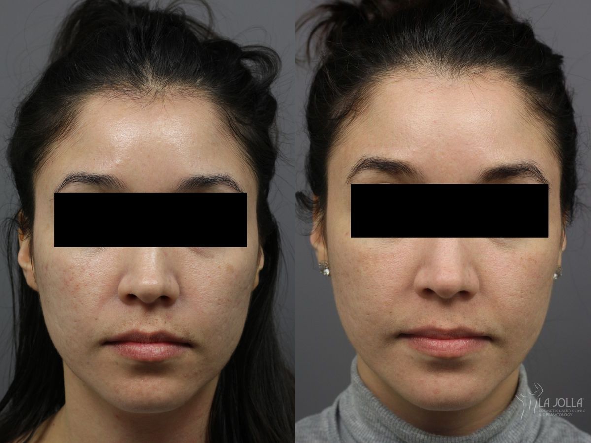 Before and after Fraxel® case 36284 - Angle 2