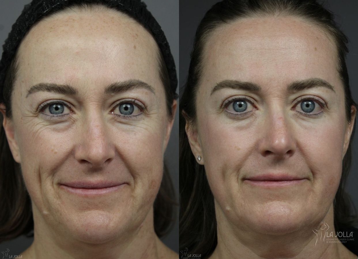 Before and after Fraxel® case 36129