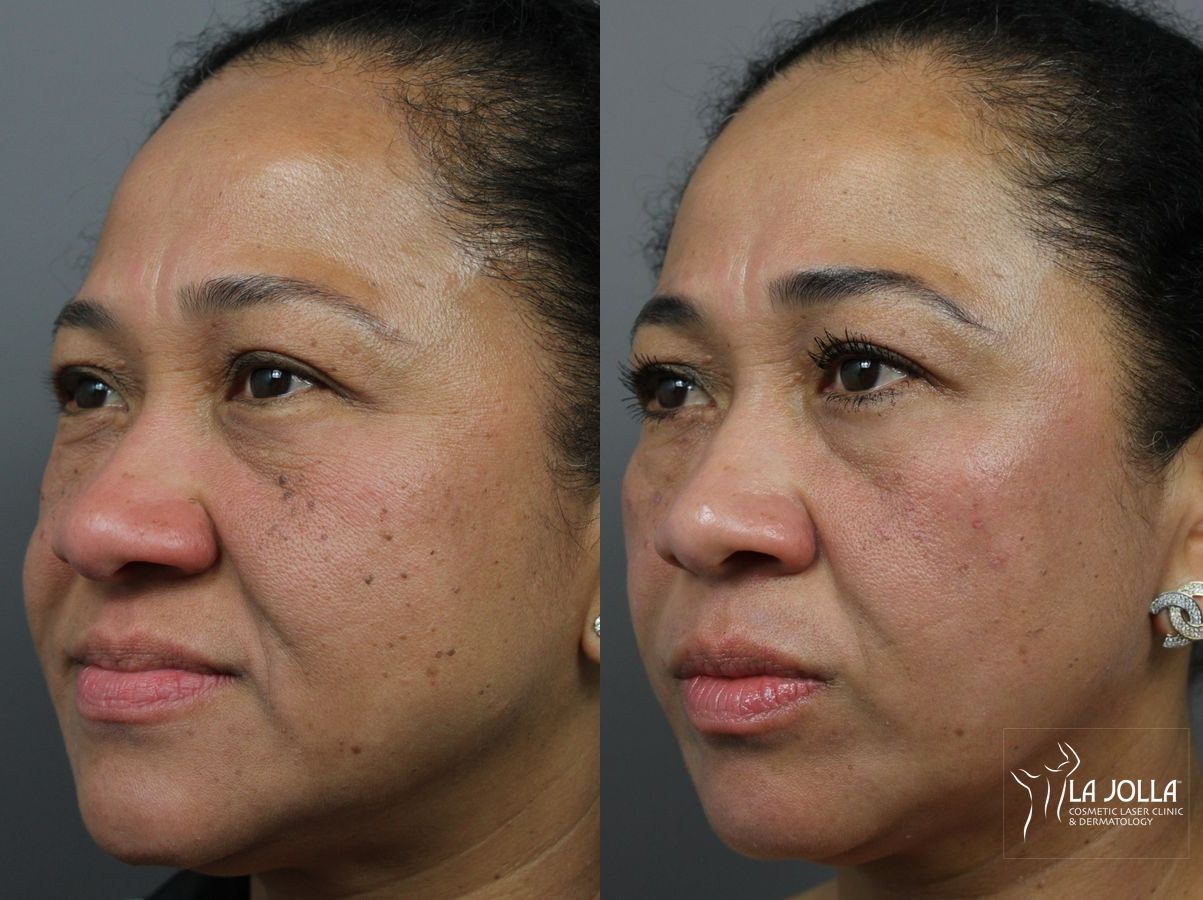 Before and after Fraxel® case 36280