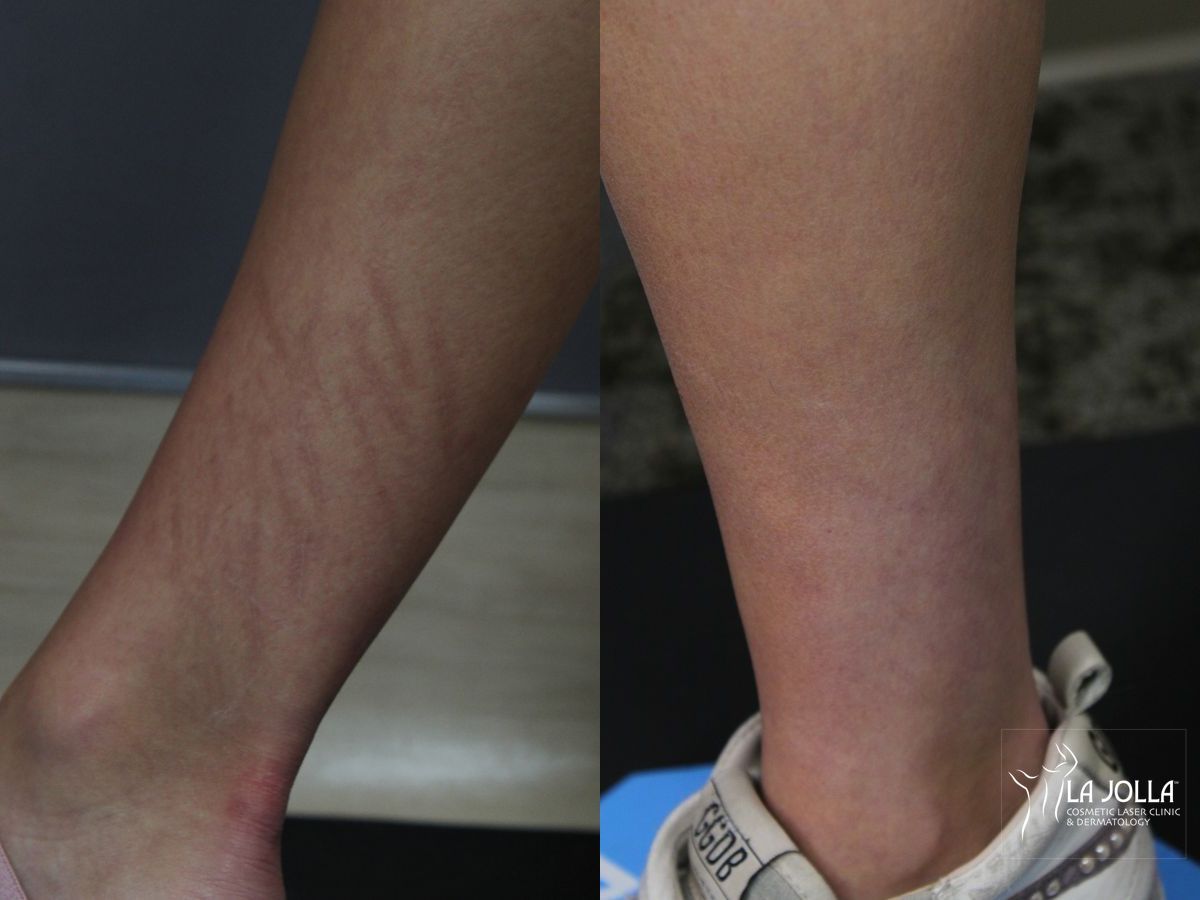 Before and after Fraxel® case 36077 - Angle 2