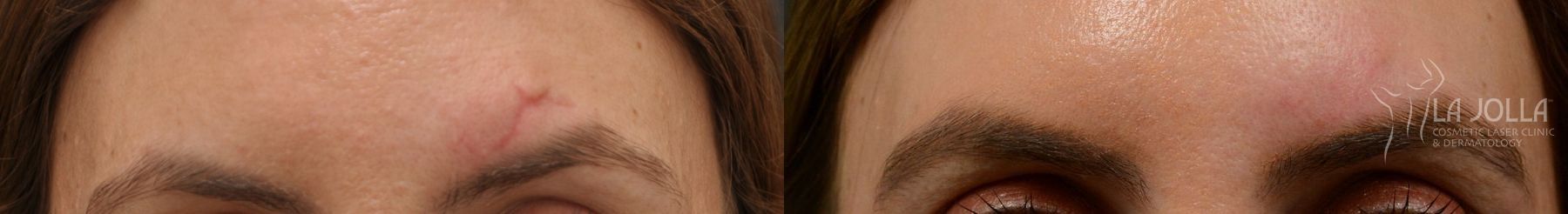 Before and after Fraxel® case 36297