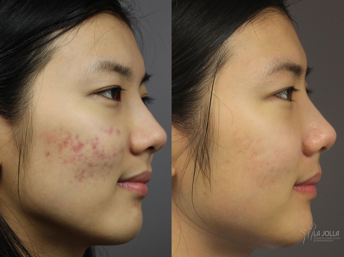 Before and after Fraxel® case 36260