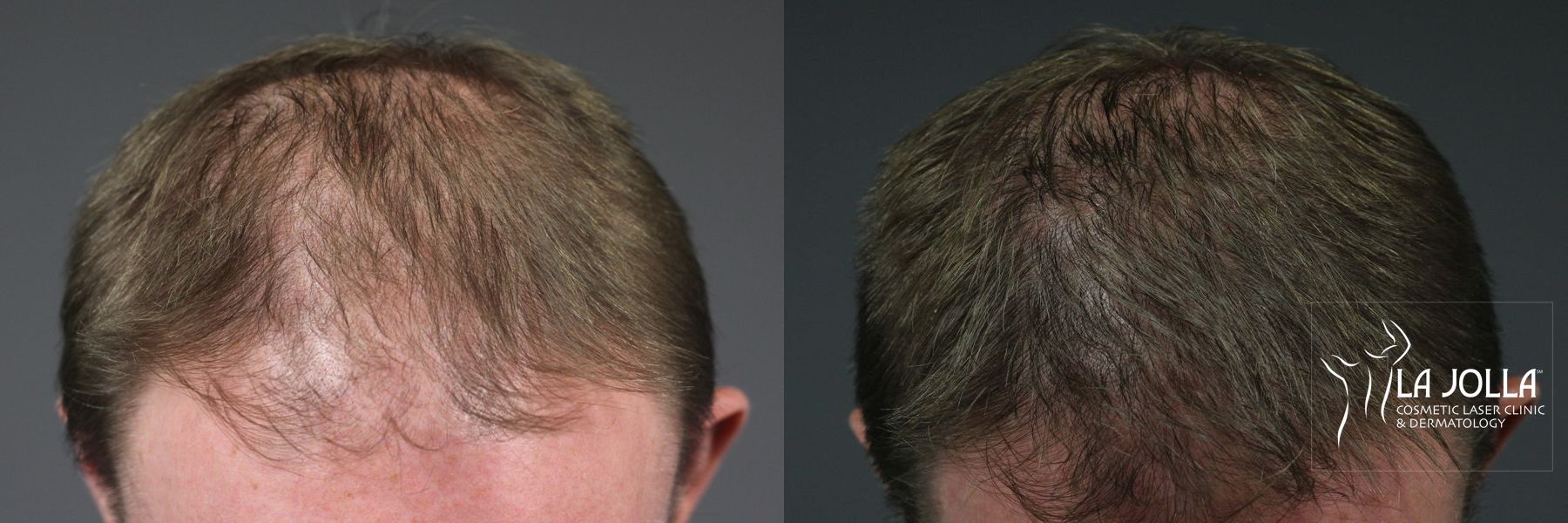 Before and after Hair Restoration case 36244