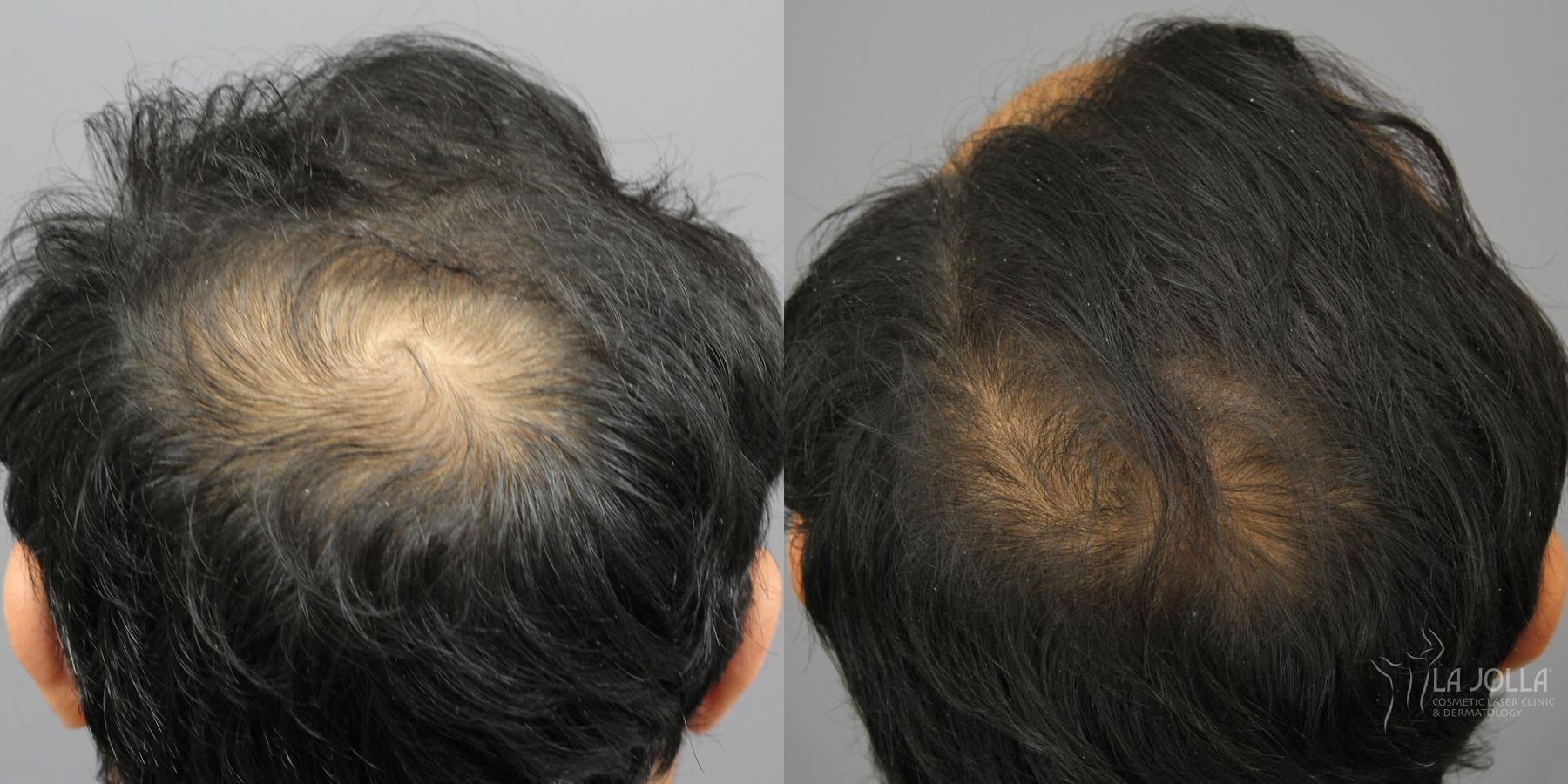 Before and after Hair Restoration case 36190