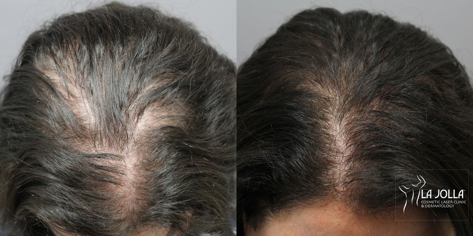 Before and after Hair Restoration case 36176