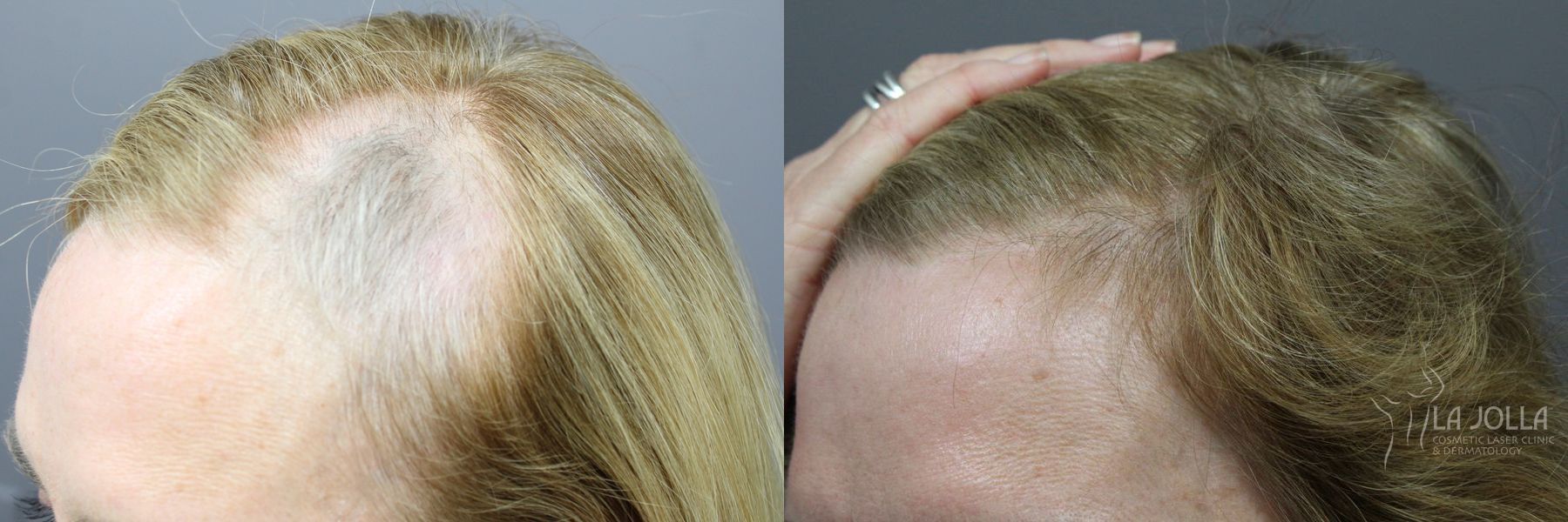 Before and after Hair Restoration case 36087