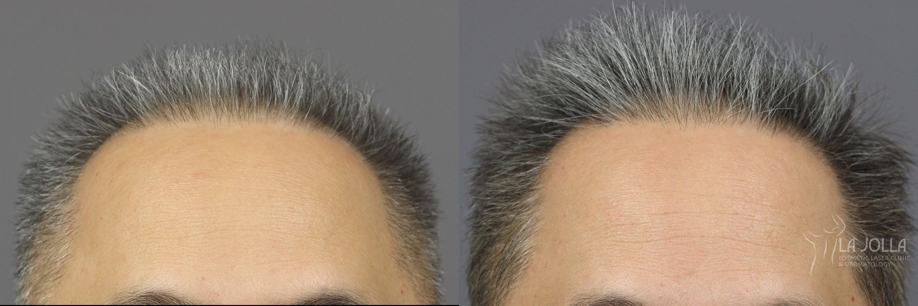 Before and after Hair Restoration case 36119 - Angle 2