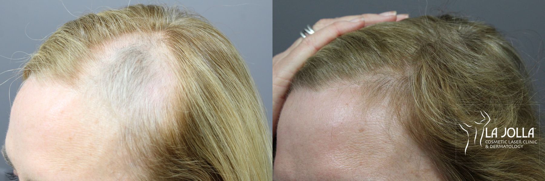 Before and after Hair Restoration case 36087