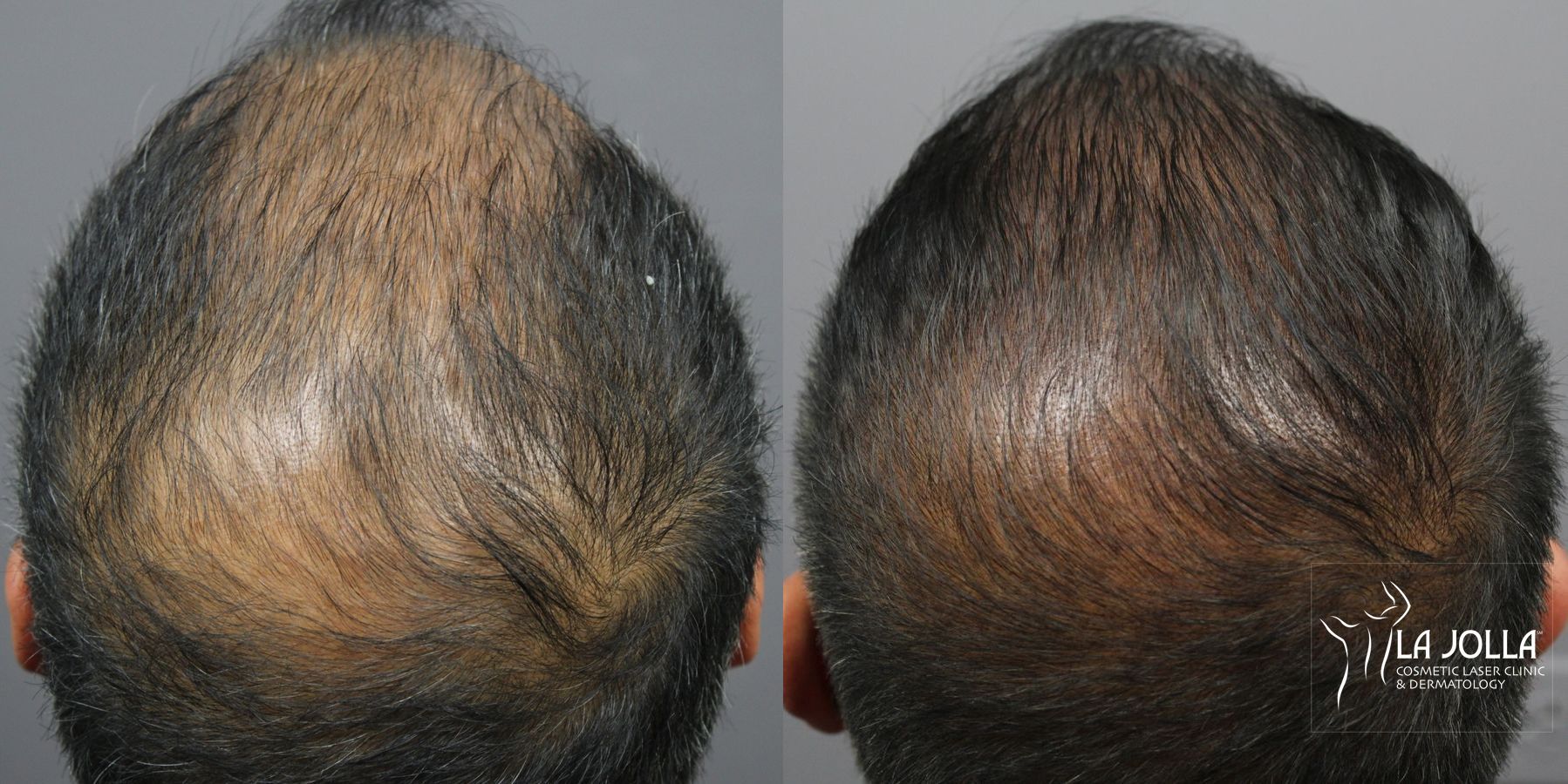 Before and after Hair Restoration case 36219