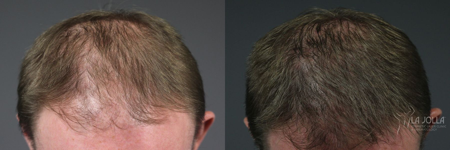Before and after Hair Restoration case 36244