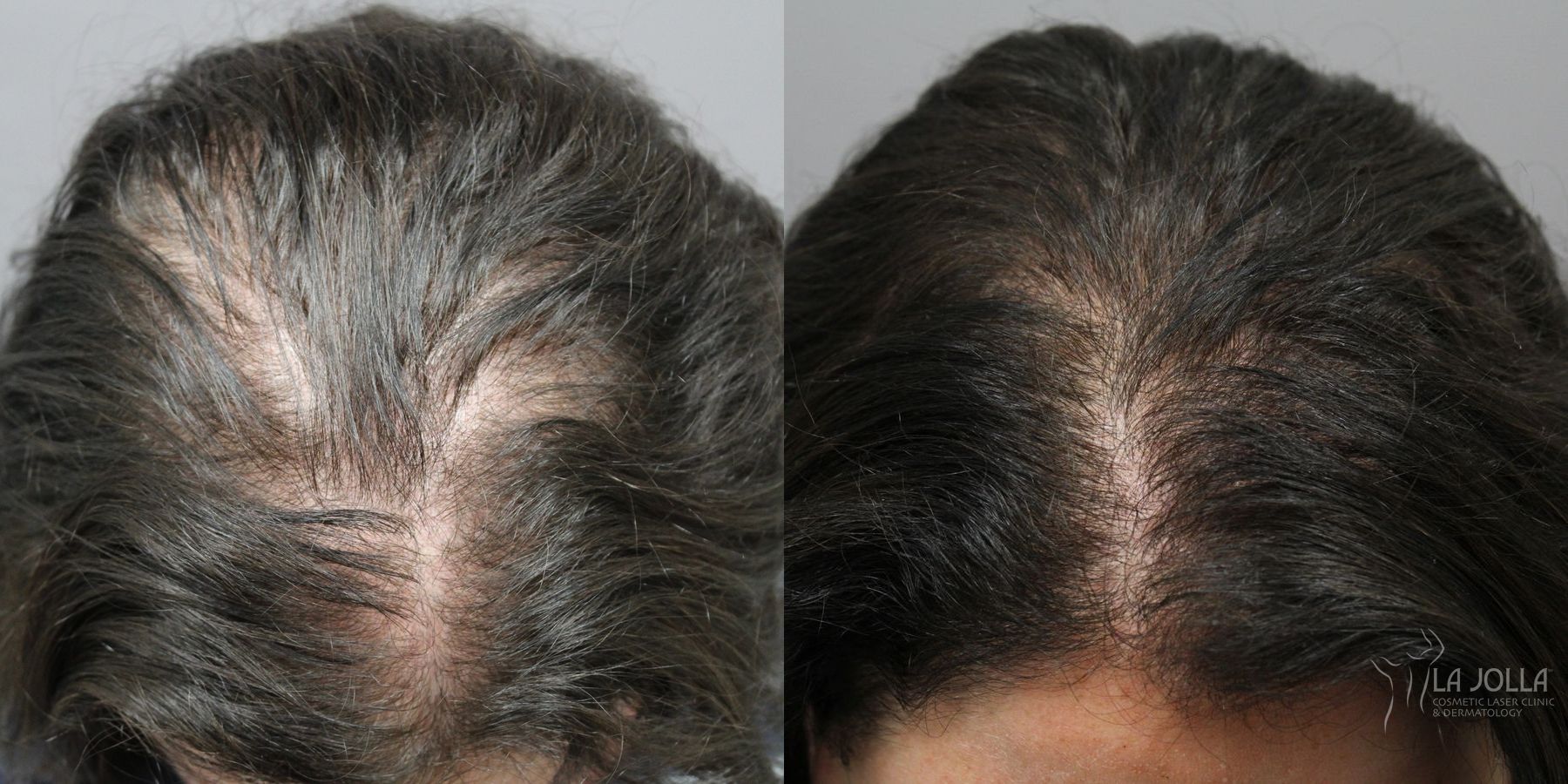 Before and after Hair Restoration case 36176