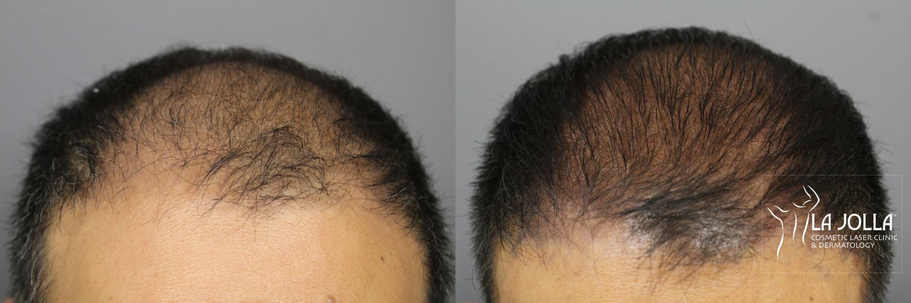 Before and after Hair Restoration case 36131
