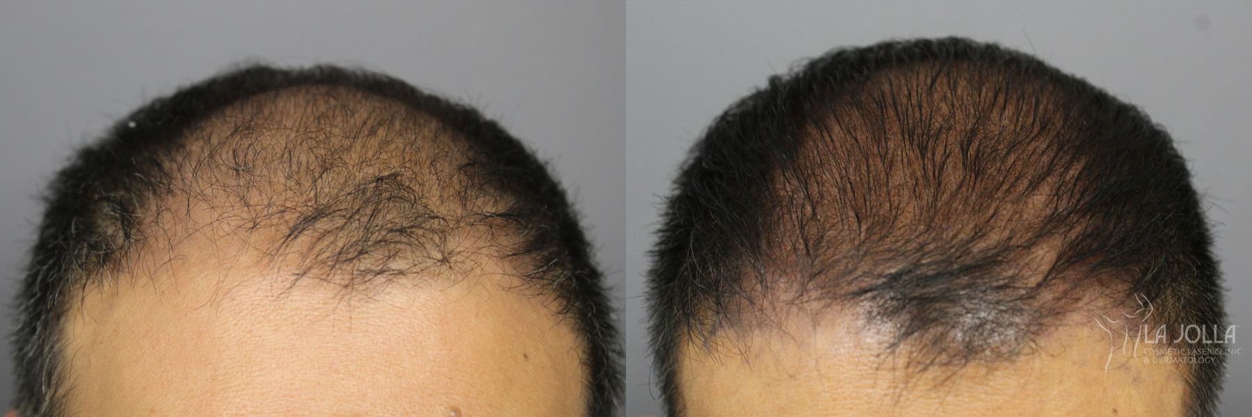 Before and after Hair Restoration case 36131