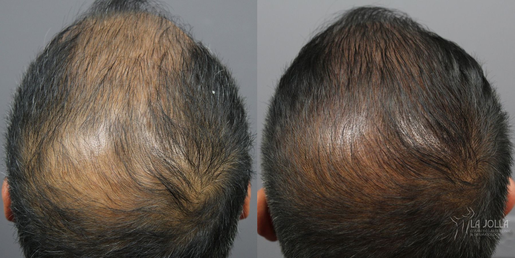 Before and after Hair Restoration case 36219